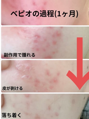 ニキビ日記 on LIPS 「ベピオゲルをはじめて1ヶ月くらい経ちました。自分自身、他の人の..」（1枚目）