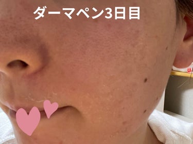 Misa🐶 on LIPS 「3日目皮がぽろぽろ剥がれてきたハリ艶感が他の人から見てもわかる..」（1枚目）