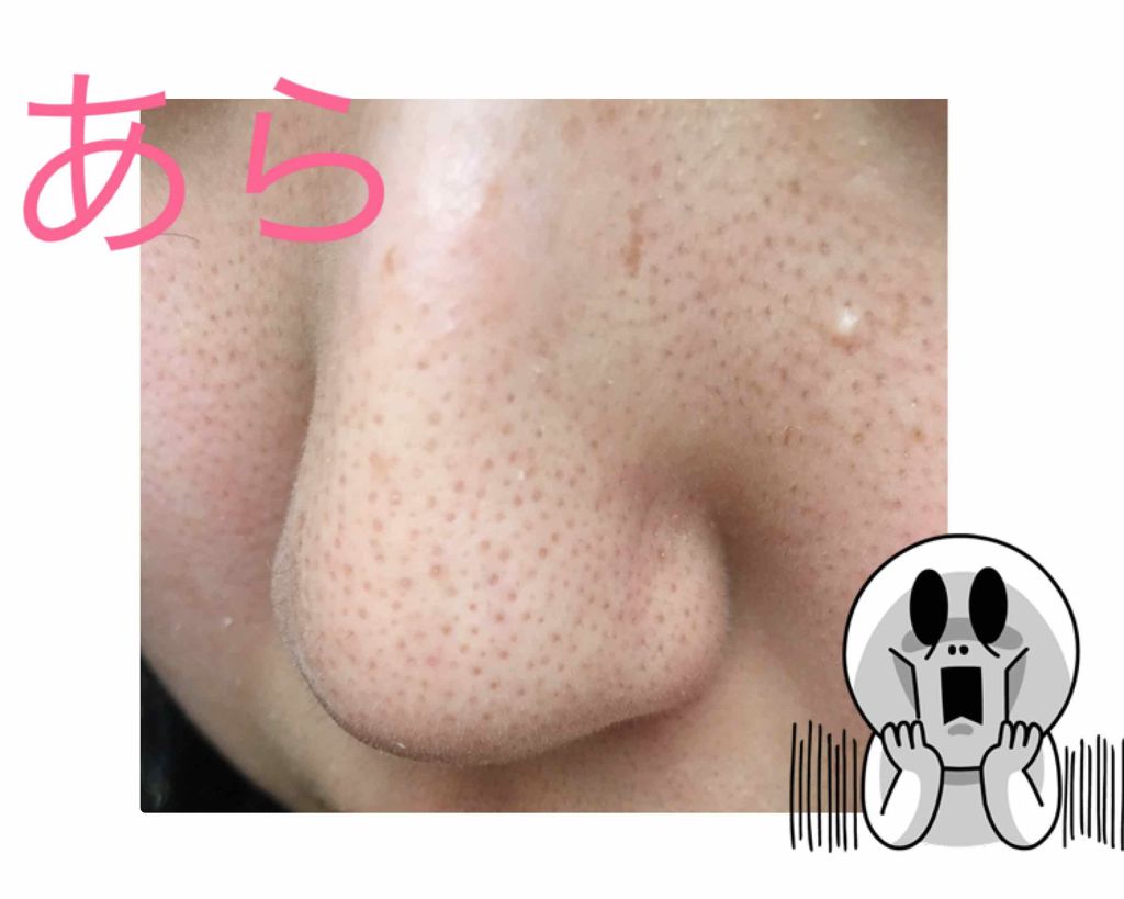 flagrant on LIPS 「この鼻、どうしたらいいですか??😭😭😭ずいぶん前から、3年以上..」(3枚目)