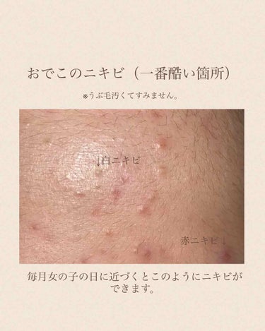 メンソレータム アクネス 薬用ふわふわな泡洗顔のクチコミ「助けてください！！ニキビを治す方法！！
本当に助けてください！！

こんにちはrrです！！
今.....」（2枚目）