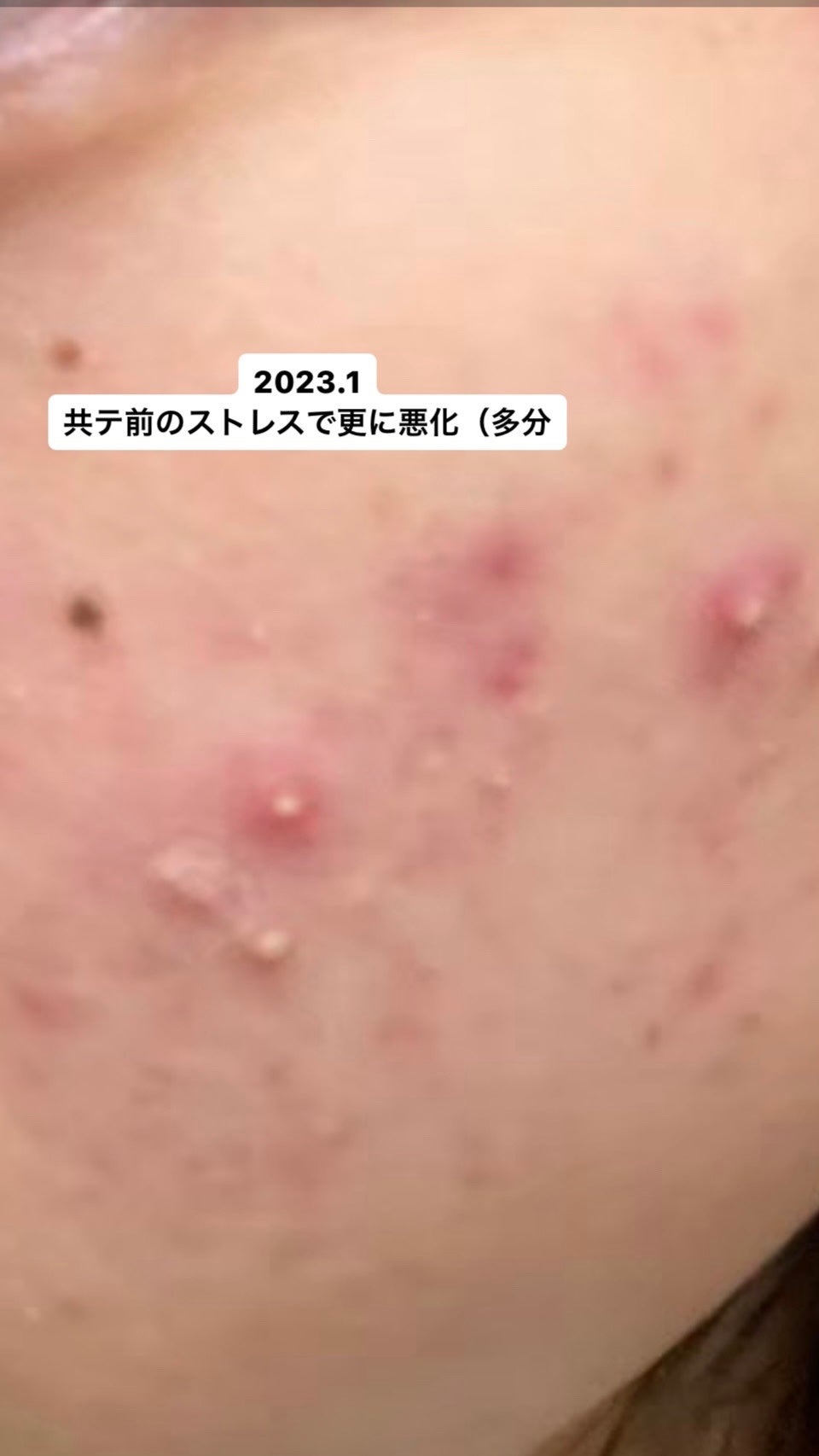 ニキビ治療薬(医薬品)/メンソレータム アクネス/その他を使ったクチコミ(4枚目)