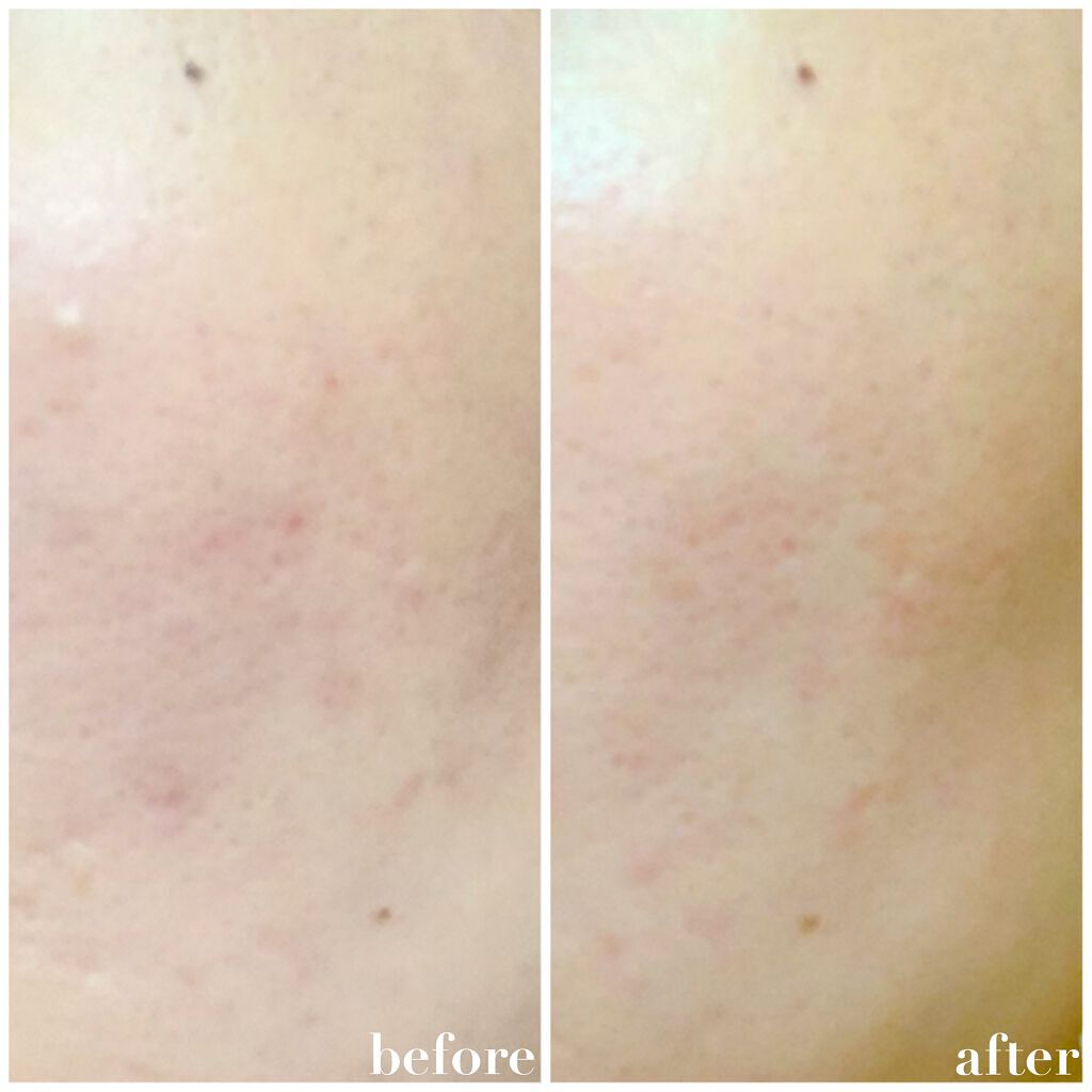 薬用しみ集中対策 プレミアム美容液/メラノCC/美容液を使ったクチコミ(2枚目)