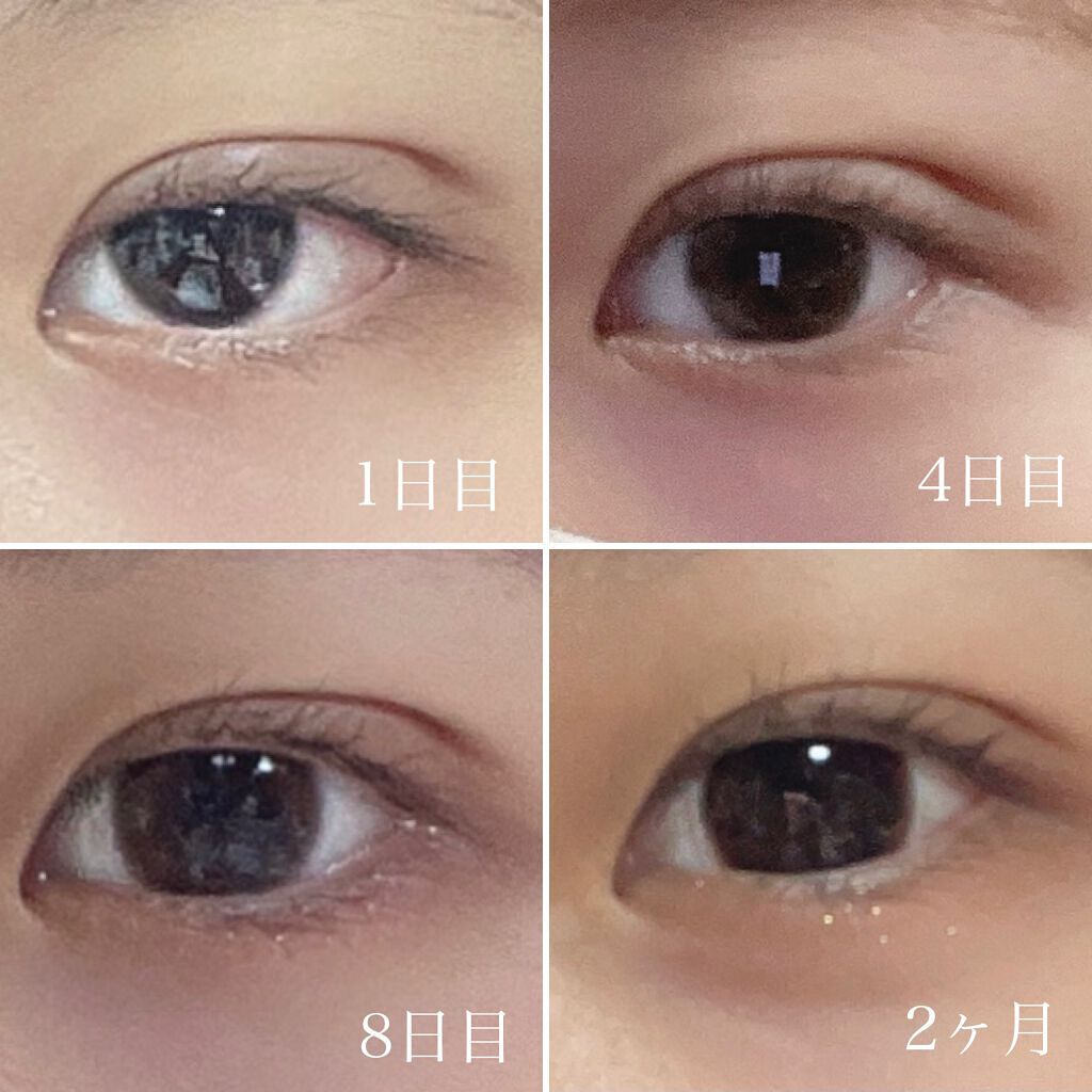 ᴀʏᴜᴍɪ on LIPS 「【アイプチ人生卒業!!埋没レポ】ずっと一重がコンプレックスでア..」(3枚目)