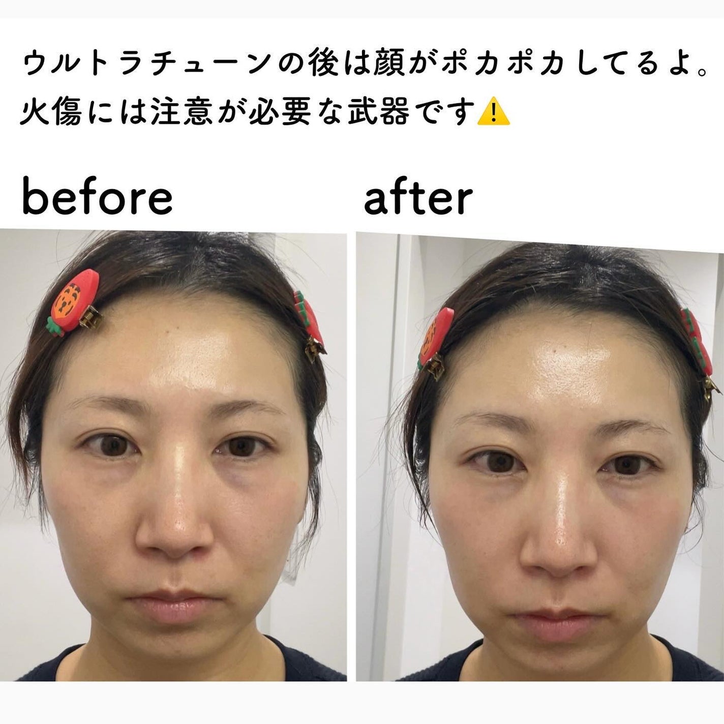 試してみた】AGE-R ウルトラチューン40.68 MEDICUBEのリアルな 試してみた】AGE-R ウルトラチューン40.68 MEDICUBEのリアルな