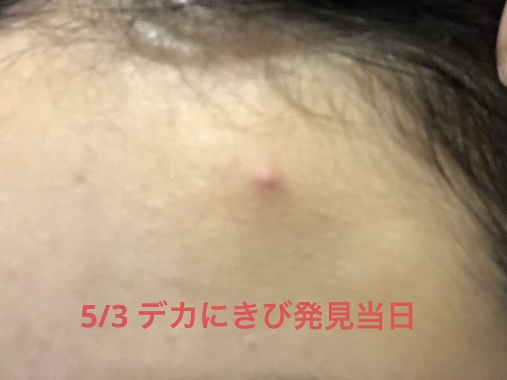 薬用 しみ 集中対策 美容液/メラノCC/美容液を使ったクチコミ（2枚目）