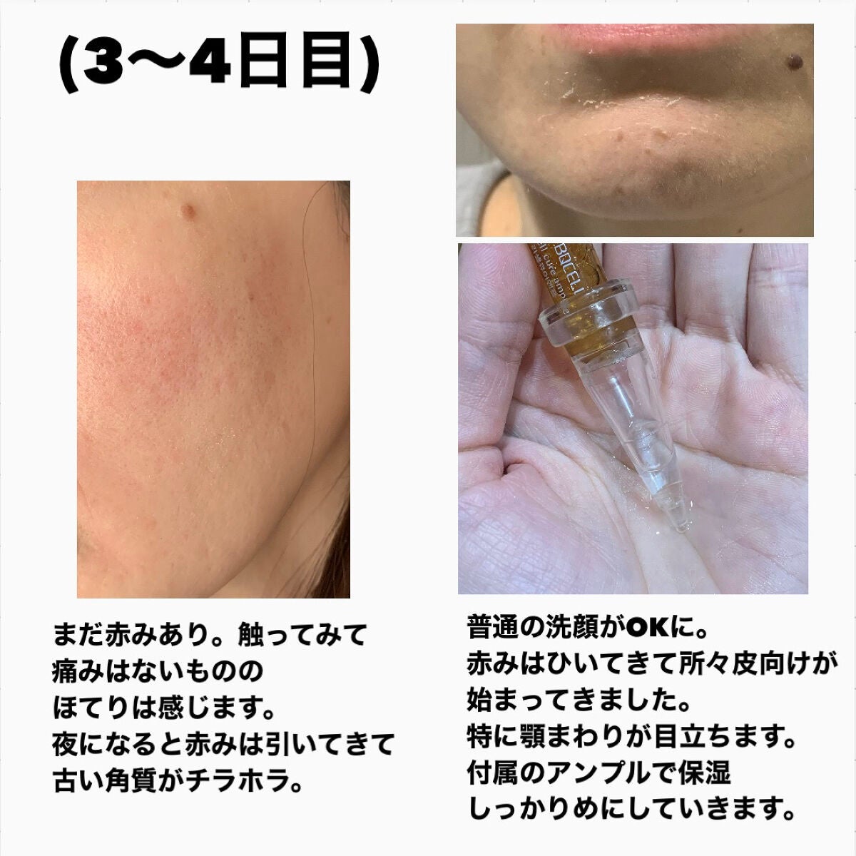 ダーマスキンピーリング/BQCELL/その他キットセットを使ったクチコミ(5枚目)