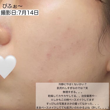 Dr.Althea オアシス スージング マスクのクチコミ「【肌悩み解決🌿にきびは1ヶ月で治せる！】

今回はだいすきなだいすきなDr.Altheaさんと.....」（2枚目）