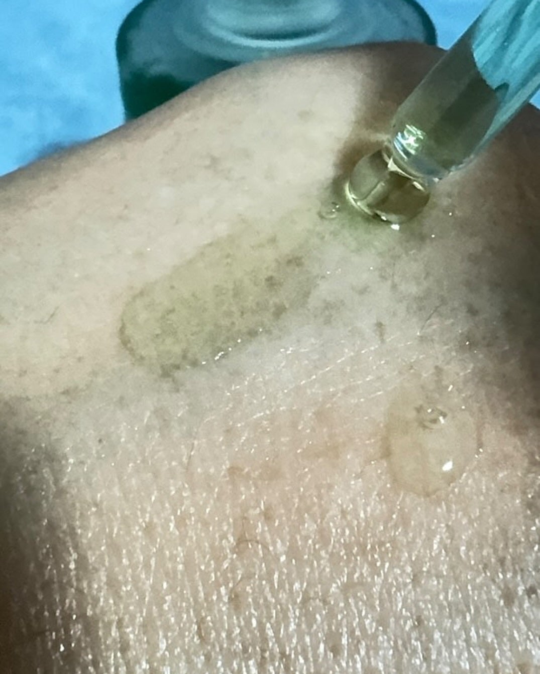 アゼライン酸15 インテンスカーミングセラム/Anua/美容液を使ったクチコミ(5枚目)