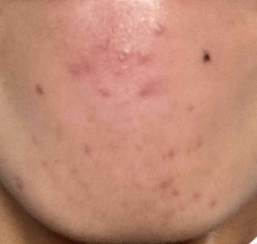 薬用 しみ 集中対策 美容液/メラノCC/美容液を使ったクチコミ(2枚目)