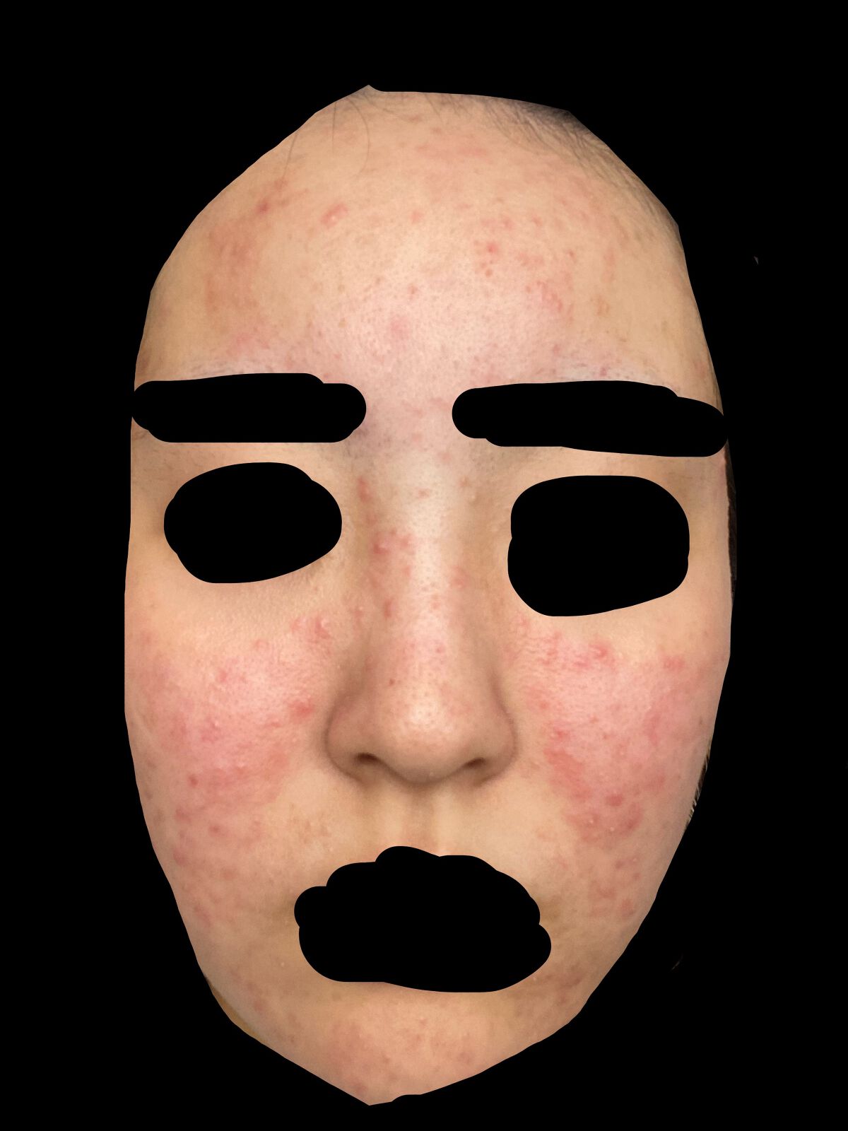 オードムーゲ 薬用ローション(ふきとり化粧水)/オードムーゲ/拭き取り化粧水を使ったクチコミ(2枚目)