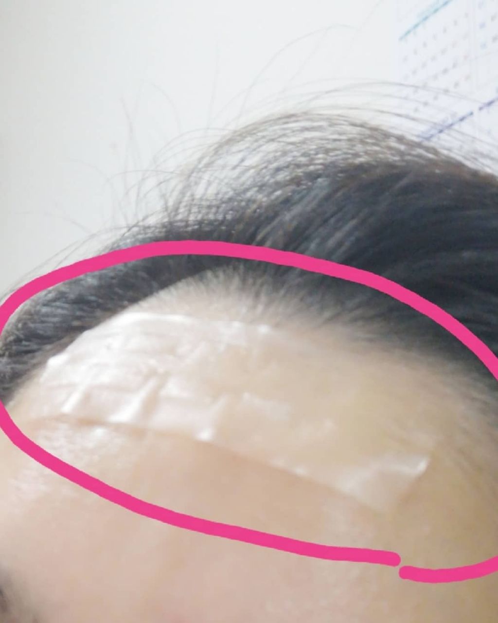 オデコディープパッチ/北の快適工房/シートマスク・パックを使ったクチコミ（2枚目）