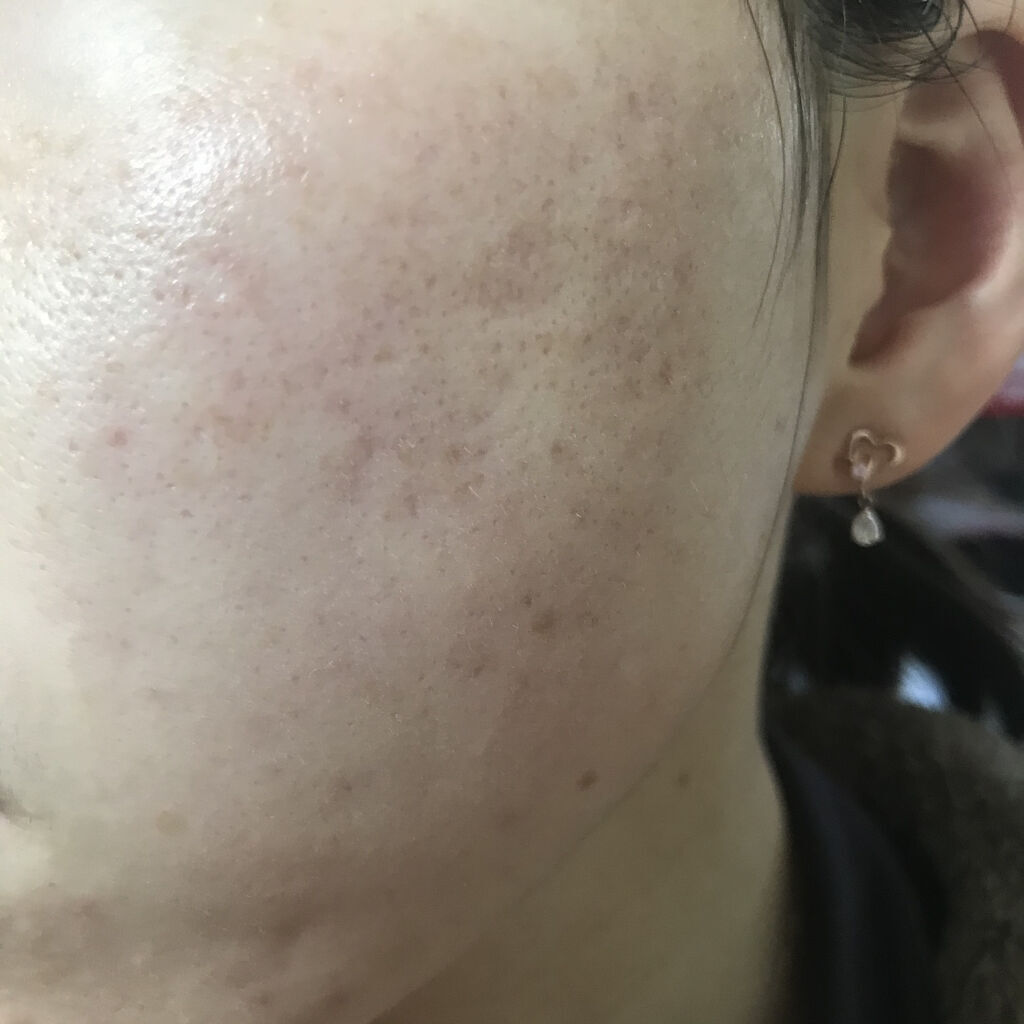 Amino Acid+B5/The Ordinary/美容液を使ったクチコミ（2枚目）