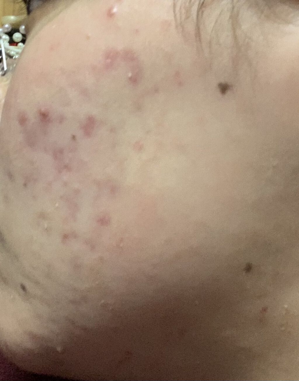 極潤プレミアムヒアルロン液(ハダラボスーパーモイスト化粧水c)/肌ラボ/化粧水を使ったクチコミ（2枚目）