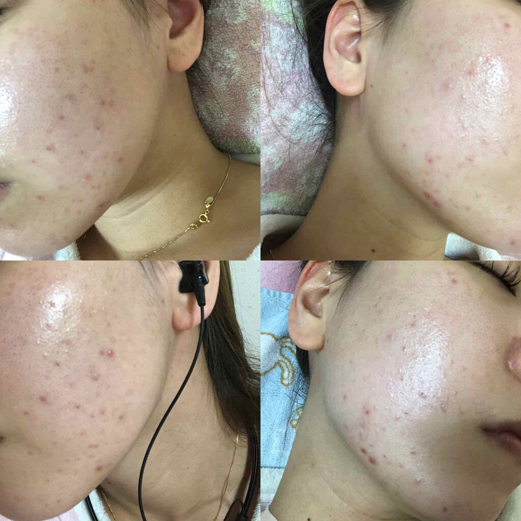 ペアアクネクリームW(医薬品)/ペア/その他を使ったクチコミ(2枚目)