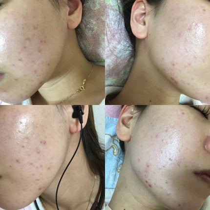 ペアアクネクリームW(医薬品)/ペア/その他を使ったクチコミ(2枚目)