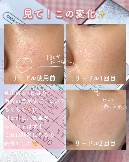 リードルショット300/VT/美容液を使ったクチコミ(5枚目)