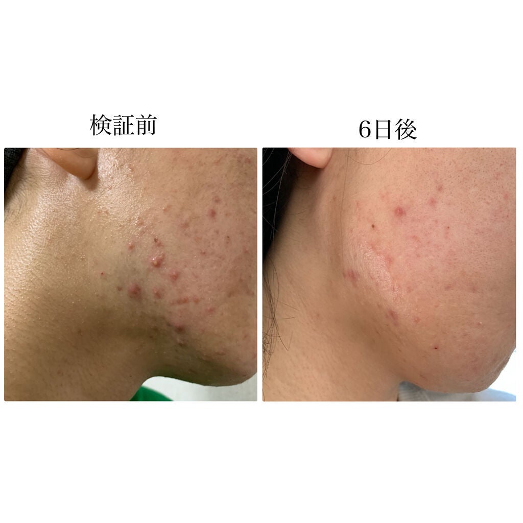 ペアアクネクリームW(医薬品)/ペア/その他を使ったクチコミ(9枚目)