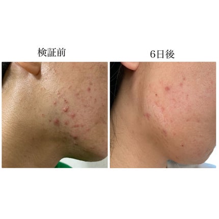 ペアアクネクリームW(医薬品)/ペア/その他を使ったクチコミ(9枚目)