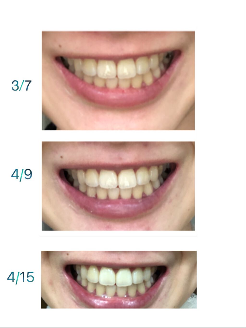 アパガードプレミオ/アパガード/歯磨き粉を使ったクチコミ(2枚目)