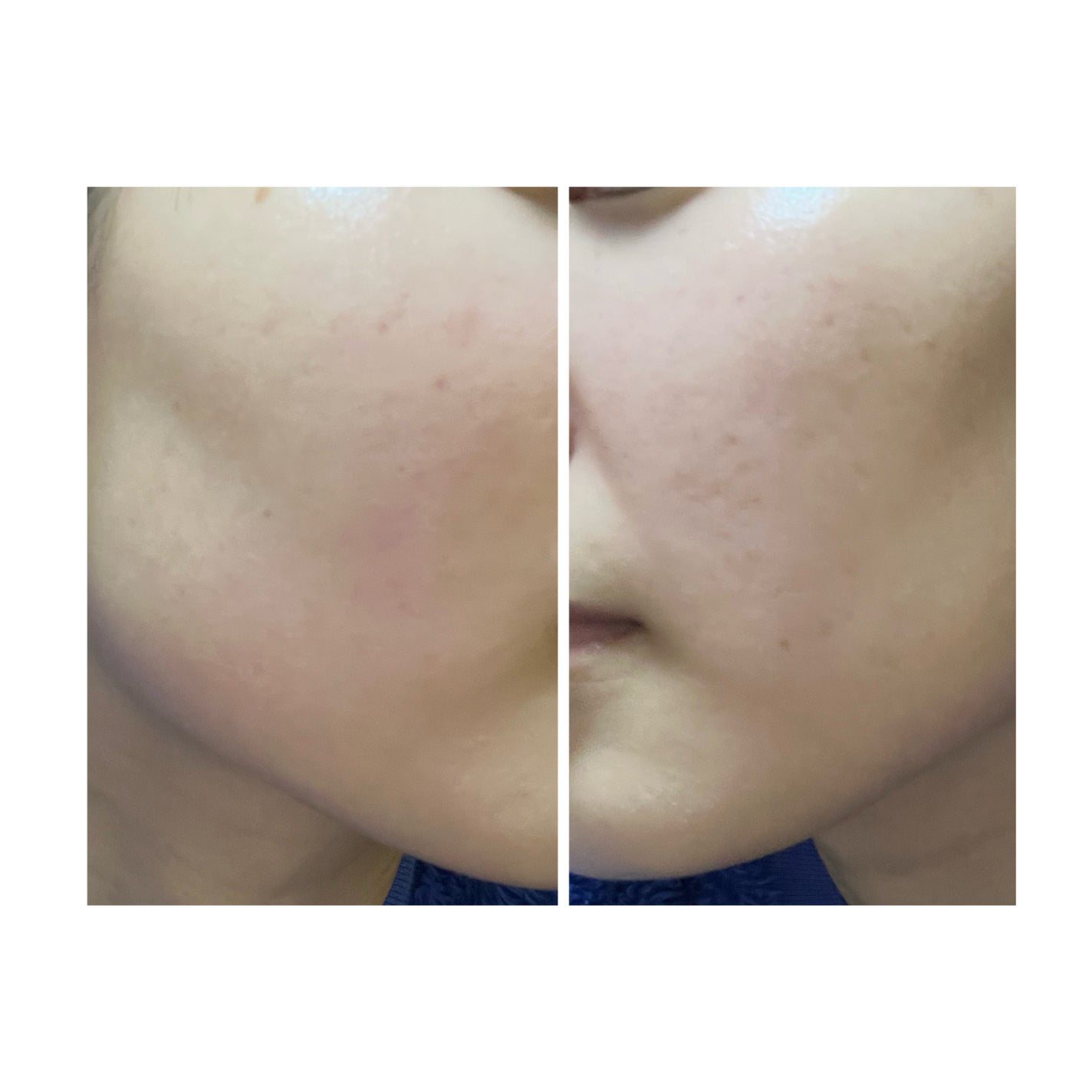 ぽむ on LIPS 「2023.9.13皮膚科に受診 エピデュオとヘパリン処方1枚目..」(1枚目)