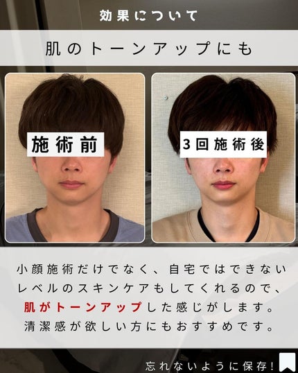 ヨウ | 31歳の老けない暮らし on LIPS 「これまで歯列矯正、脱毛、美容医療など受けてきましたが、密かに小..」(5枚目)