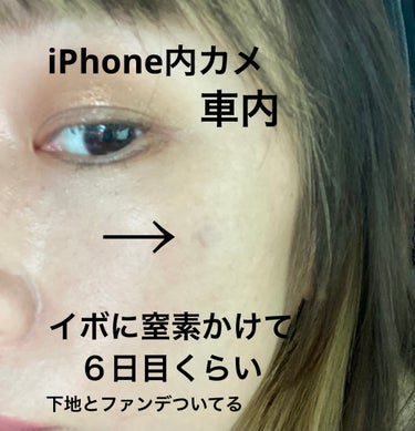 ためしたがり42歳 on LIPS 「イボの様子。ヒイイィィ。蛍光灯下の肌ひどくて現実辛い。加工した..」（1枚目）