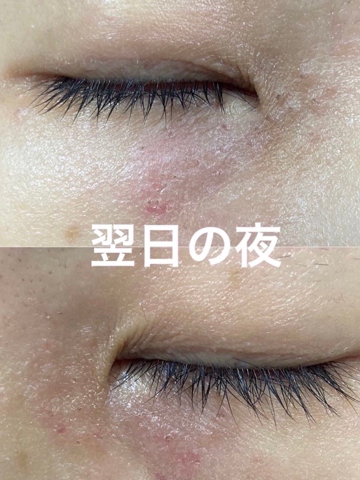 みっすん on LIPS 「目の下のポツポツをアグネスで治療してみた───────────..」(4枚目)