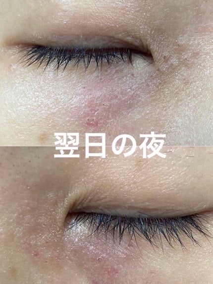 みっすん on LIPS 「目の下のポツポツをアグネスで治療してみた───────────..」(4枚目)