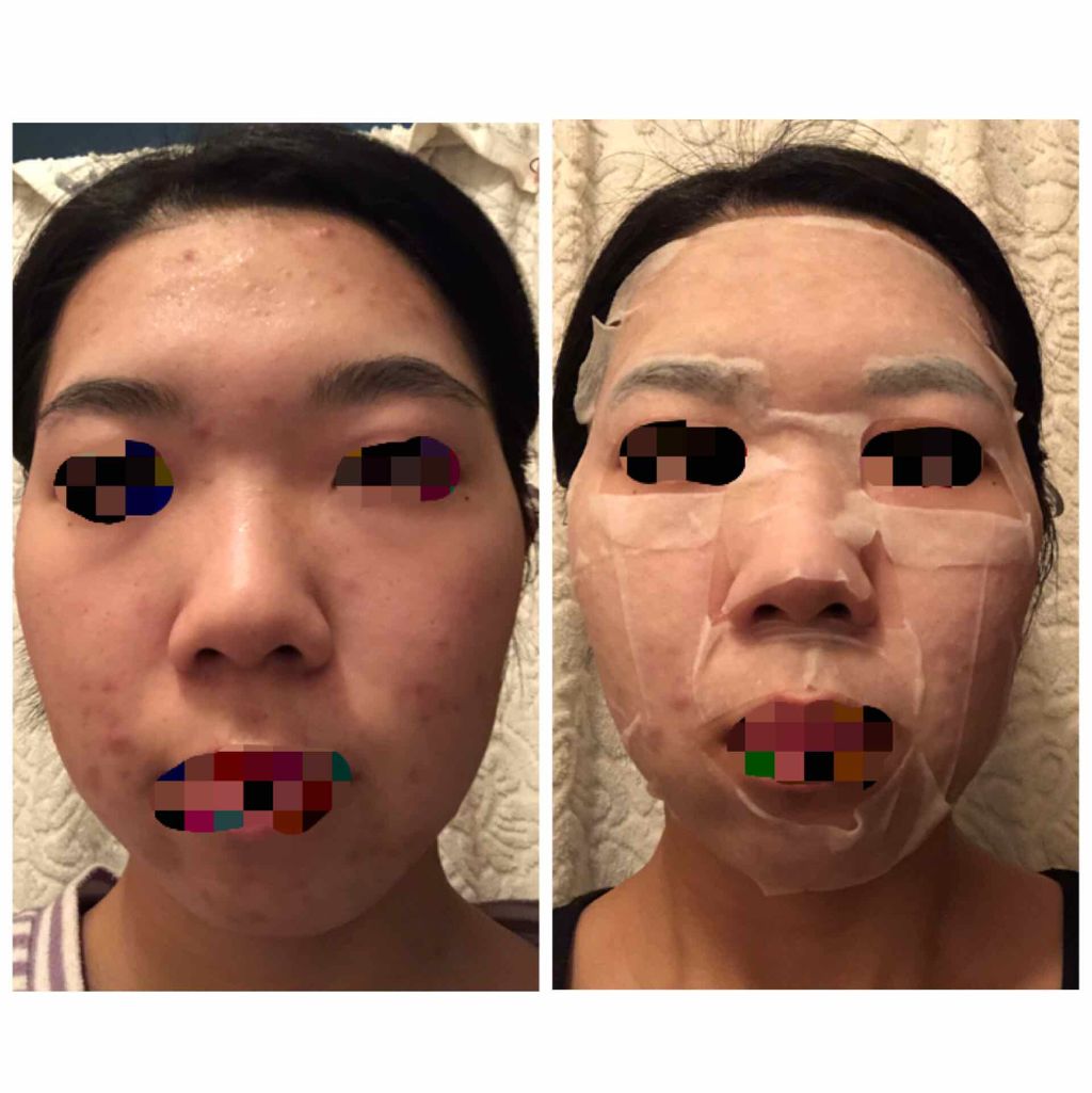 はとむぎ美肌マスク はとむぎ本舗を使った口コミ 2枚目汚肌あります ハトムギ美肌マス By はるか 脂性肌 代前半 Lips はとむぎ美肌マスク はとむぎ本舗を使った口コミ 2枚目汚肌あります ハトムギ美肌マス By はるか 脂性肌 代前半 Lips
