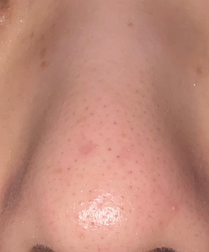ぽてと on LIPS 「今日は鼻の黒ずみ毛穴がワセリンでどれくらいなくなるかを検証して..」(2枚目)
