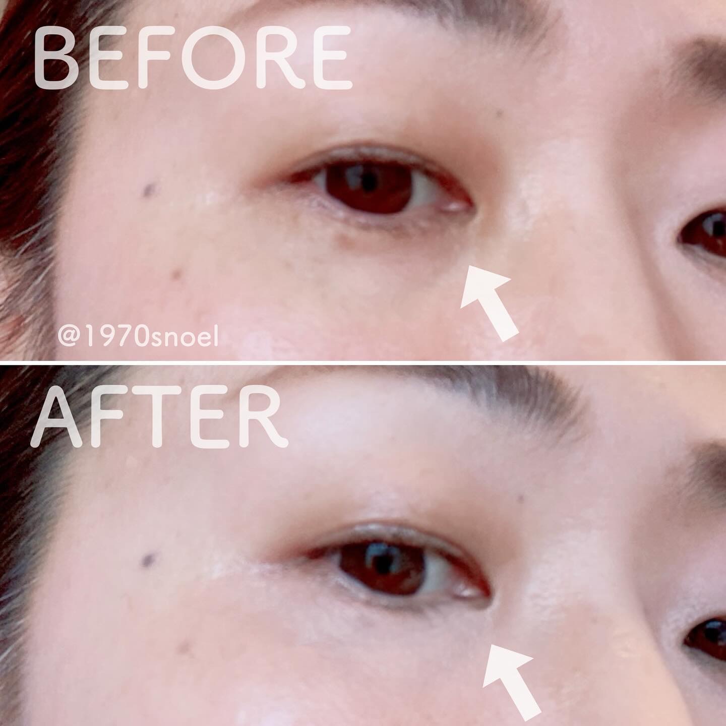 デイジードール コンシーラー パレット/DAISY DOLL by MARY QUANT/パレットコンシーラーを使ったクチコミ（3枚目）