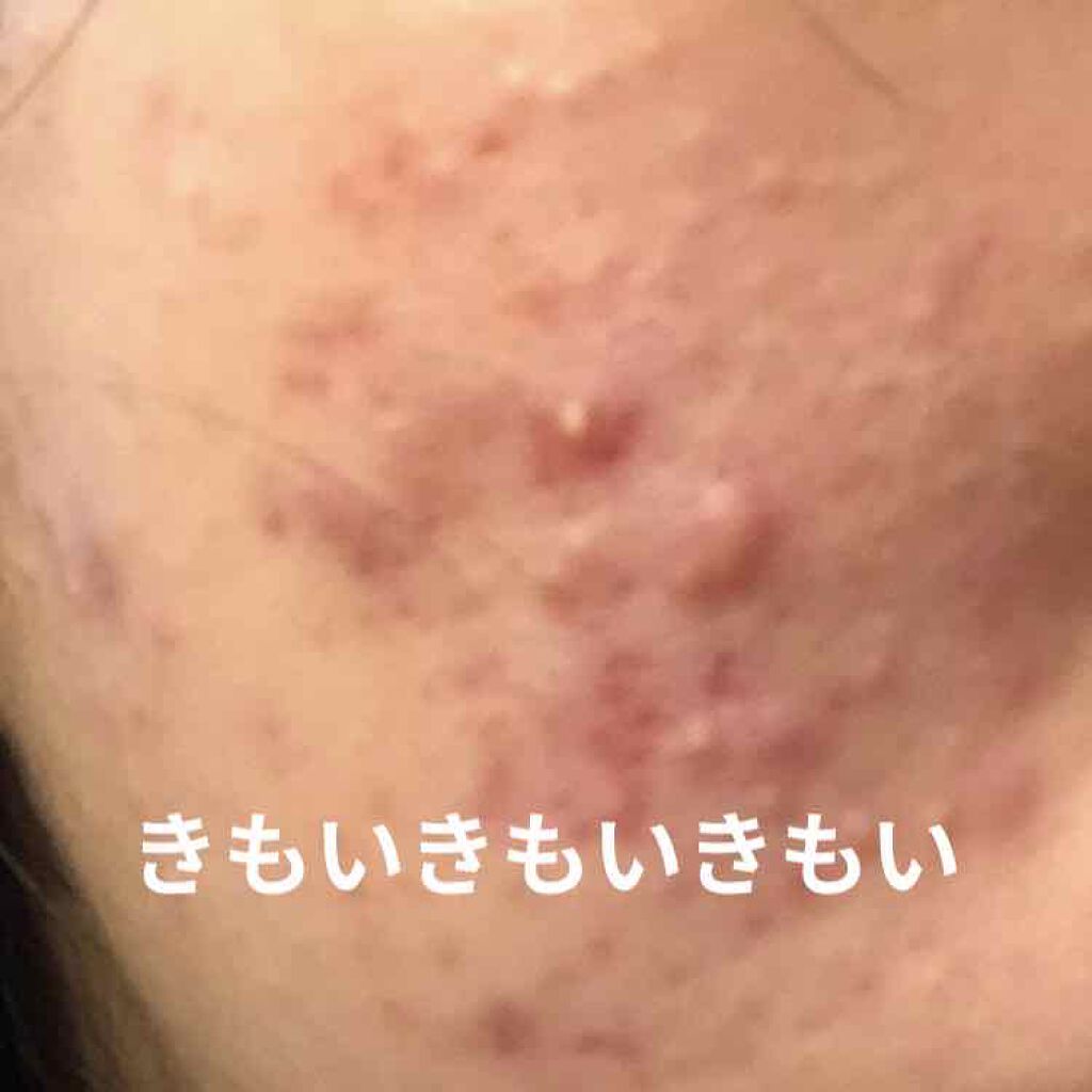 エピデュオゲル/マルホ株式会社/その他を使ったクチコミ（2枚目）