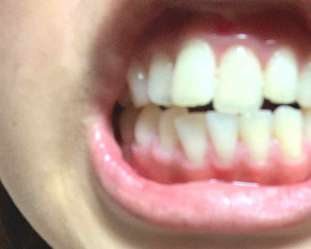 クレスト3Dホワイトニング ホワイトストリップ プロフェッショナル エフェクツ/クレスト/その他オーラルケアを使ったクチコミ(4枚目)