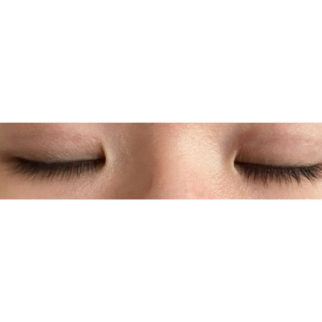 二重整形/その他を使ったクチコミ（2枚目）