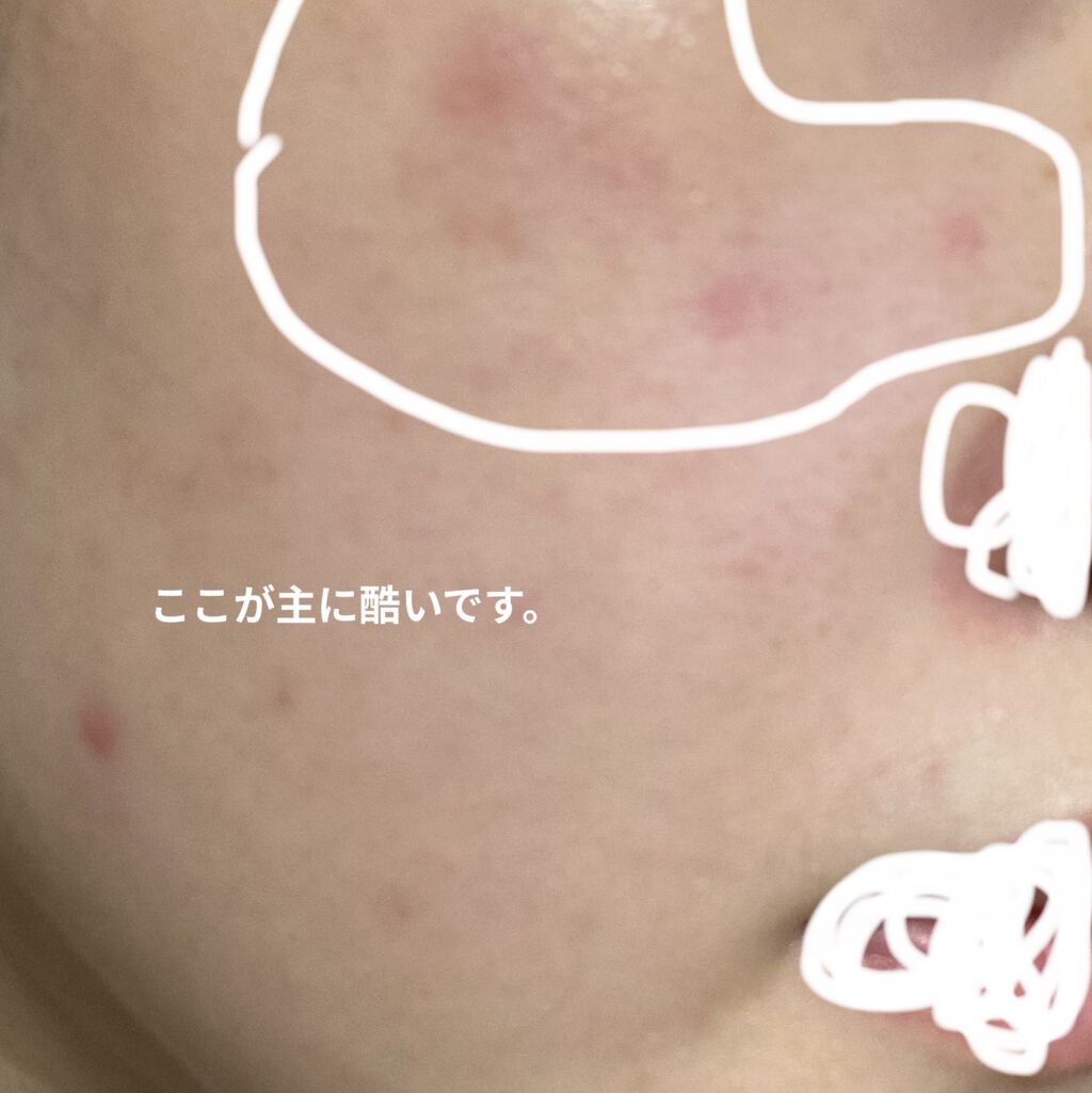 ドクタージャルト シカペア リカバー (第2世代）/Dr.Jart＋/フェイスクリームを使ったクチコミ（3枚目）