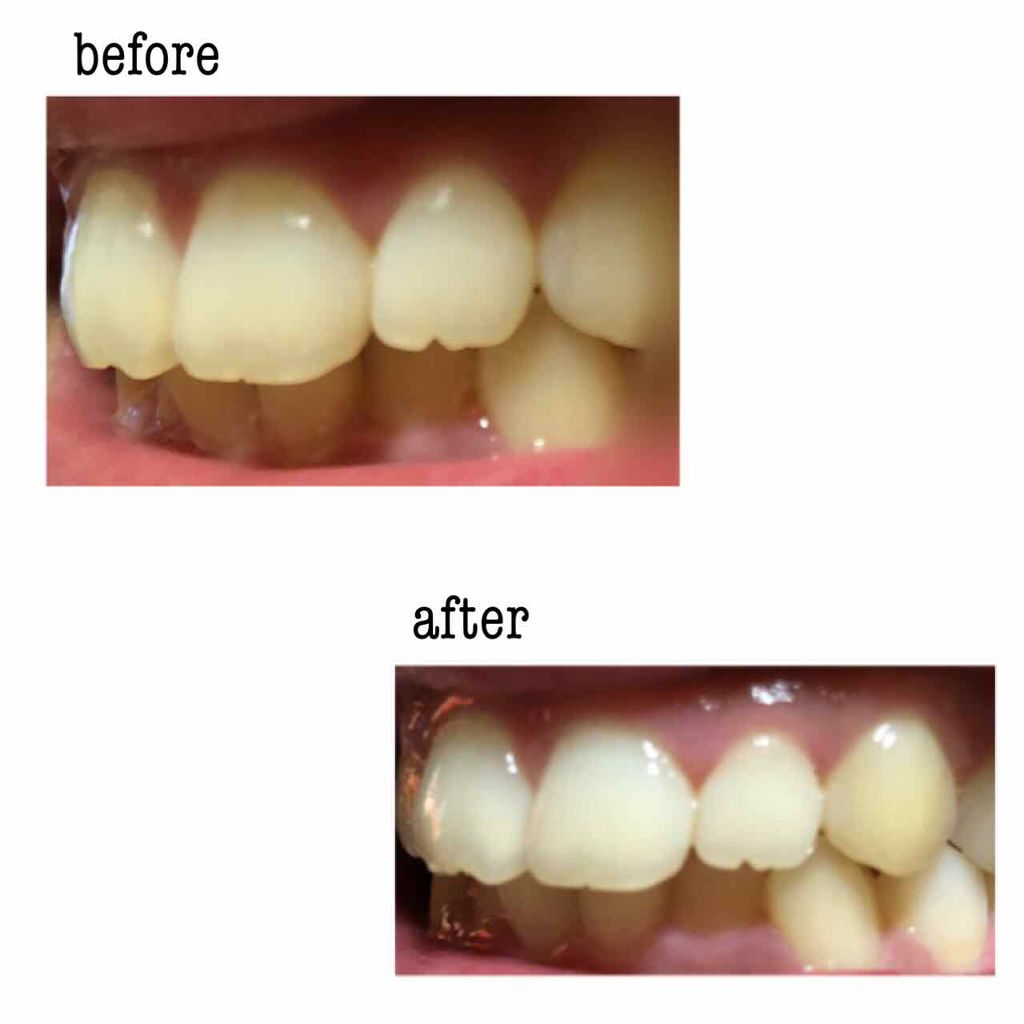 プレミアム ステインクリア ペースト/オーラツー/歯磨き粉を使ったクチコミ（2枚目）