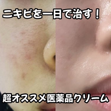 ペア ペアアクネクリームW(医薬品)のクチコミ「何しても治らない💦💦そんなニキビにオススメな医薬品！💊



♡ペア
ペアアクネクリームW　医.....」（1枚目）