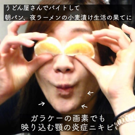 おゆみ|ニキビ・ニキビ跡ケア on LIPS 「グルテンフェイスって知ってますか?☑︎頬が膨れている(..」(4枚目)