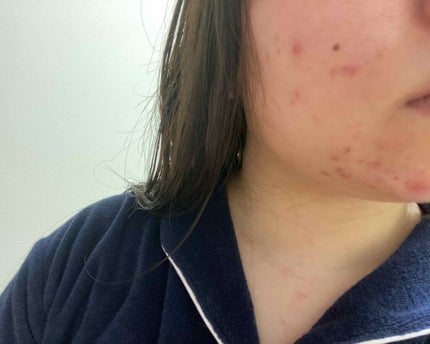 薬用 リペア ローション/アクネオ/化粧水を使ったクチコミ(3枚目)