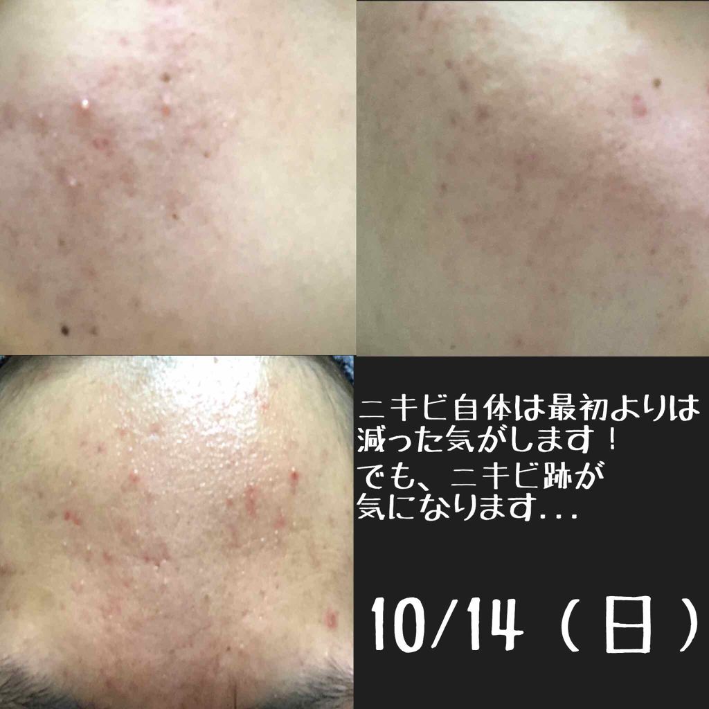 バイオイル/バイオイル/フェイスオイルを使ったクチコミ（2枚目）