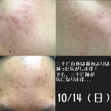 バイオイル/バイオイル/フェイスオイルを使ったクチコミ(2枚目)