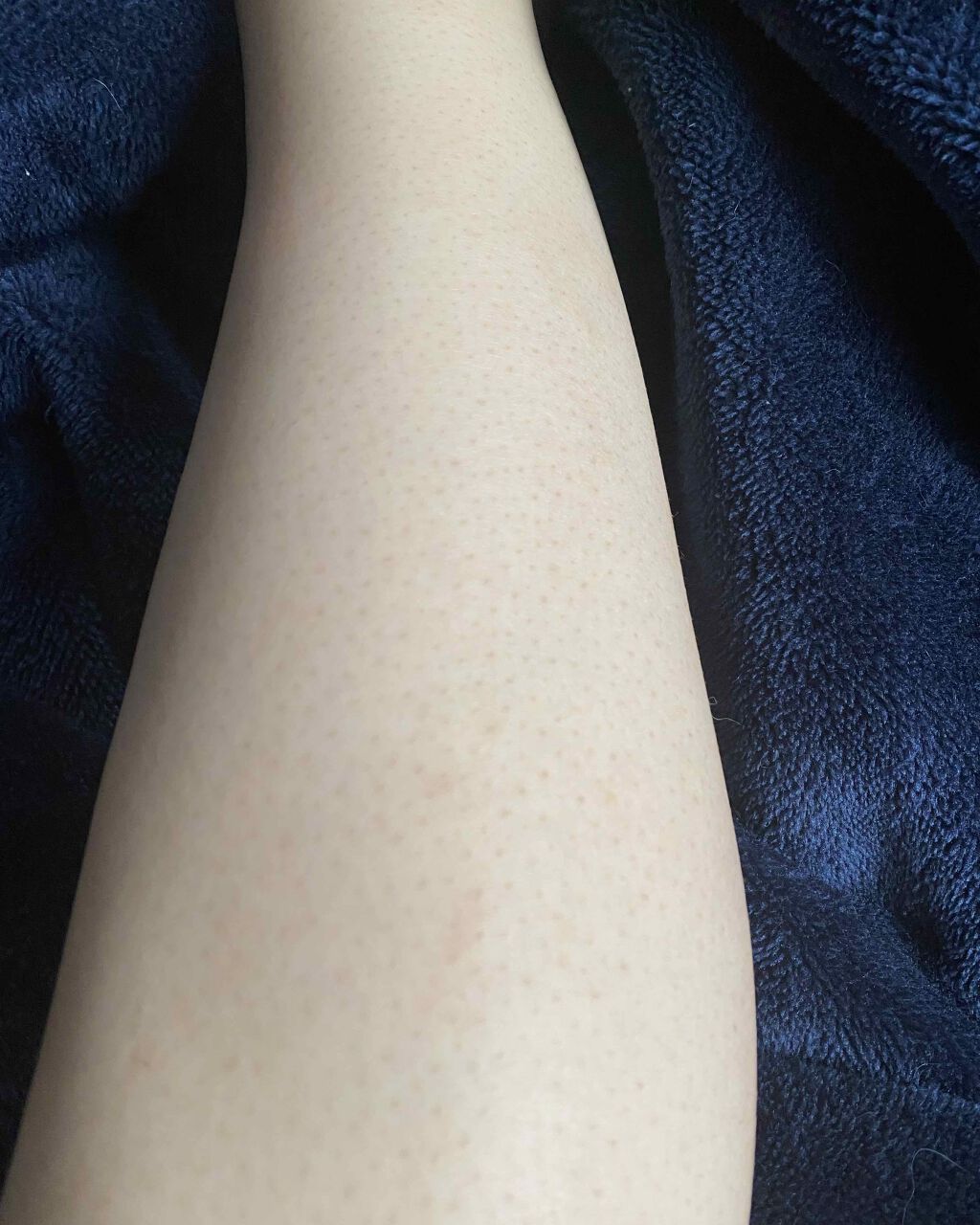 光脱毛器 VIO/Sarlisi/家庭用脱毛器を使ったクチコミ(1枚目)