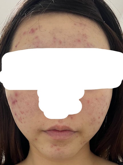 わこ on LIPS 「もう7年くらいニキビに悩まされています。皮膚科も何箇所か通いま..」(5枚目)