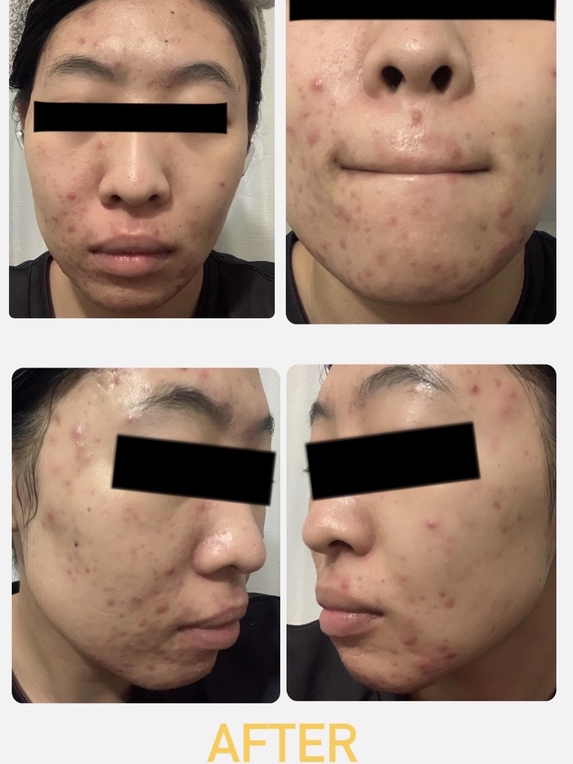 ドクダミ 77 スージングトナー/Anua/化粧水を使ったクチコミ（2枚目）