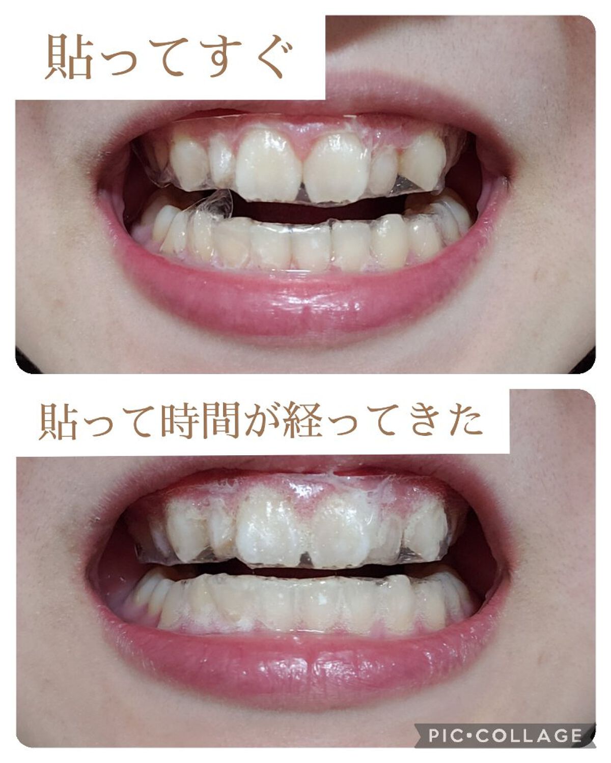 クレスト3Dホワイトニング ホワイトストリップ プロフェッショナル エフェクツ/クレスト/その他オーラルケアを使ったクチコミ(8枚目)