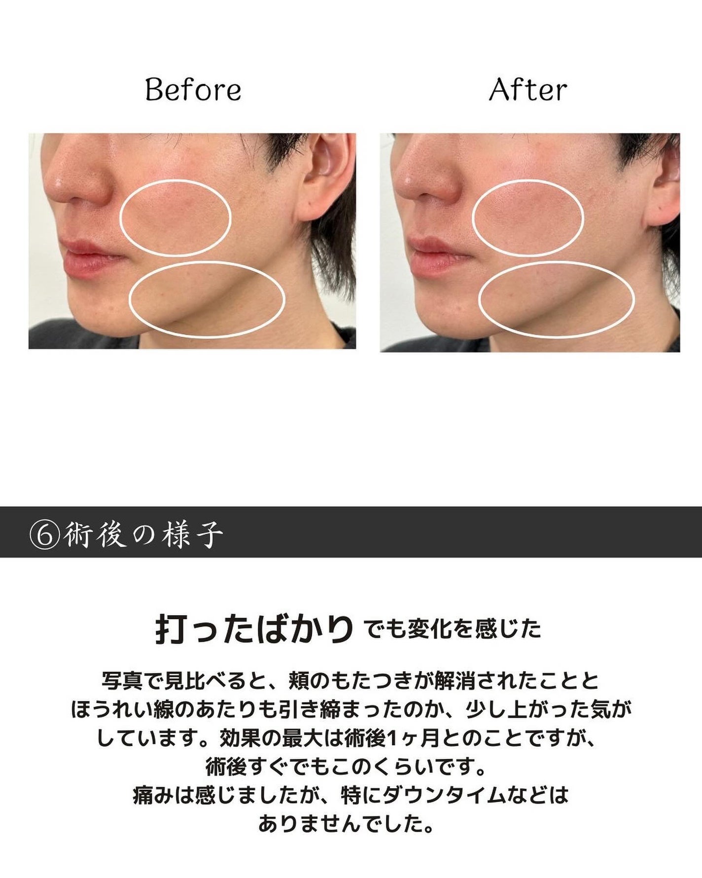 ヒロキ|40歳の美容家 ヘアケア スキンケア on LIPS 「美容が好きな人🙌___________ ダウンタイムなしで、今..」(7枚目)