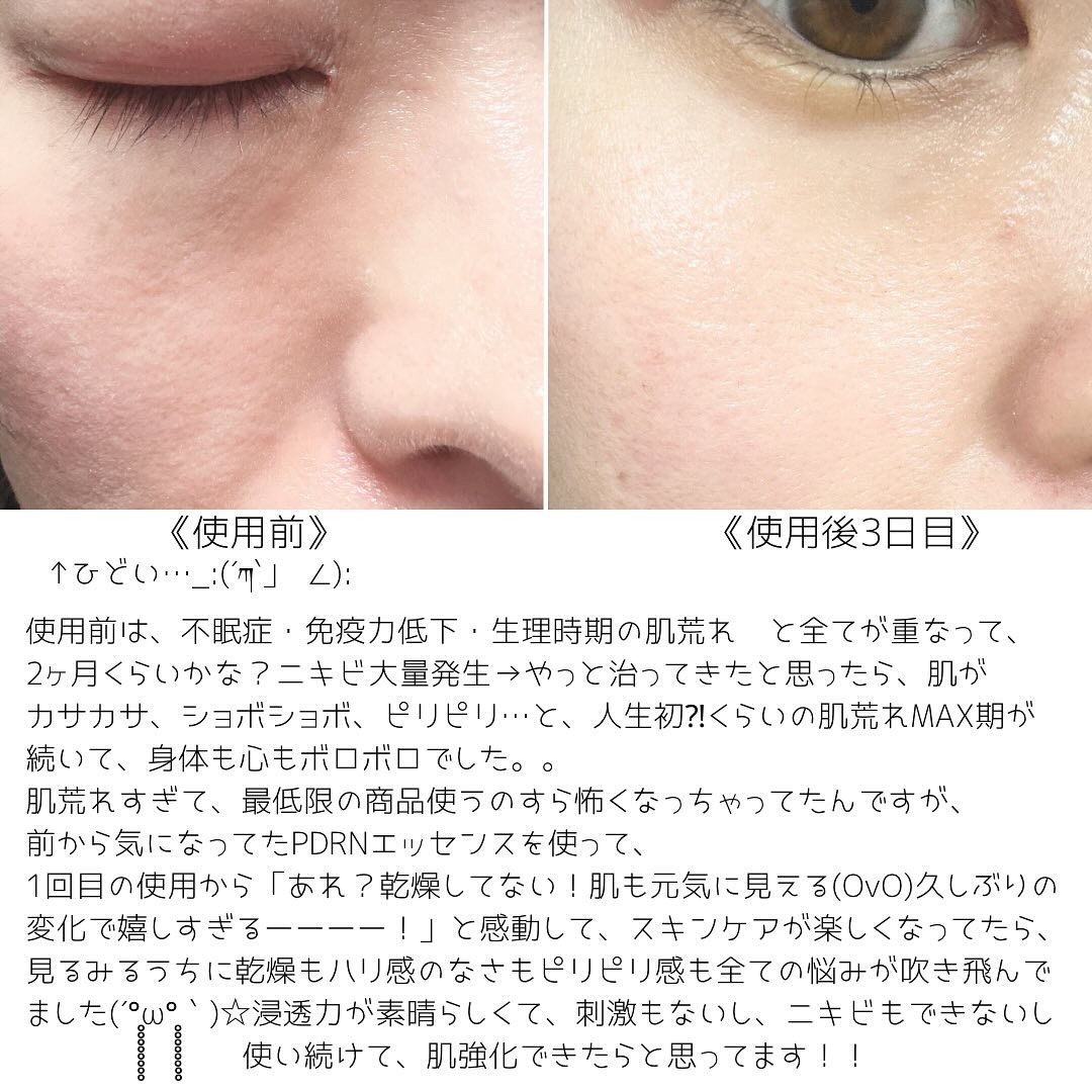 VTの美容液 リードルショット300他、1商品を使った口コミ