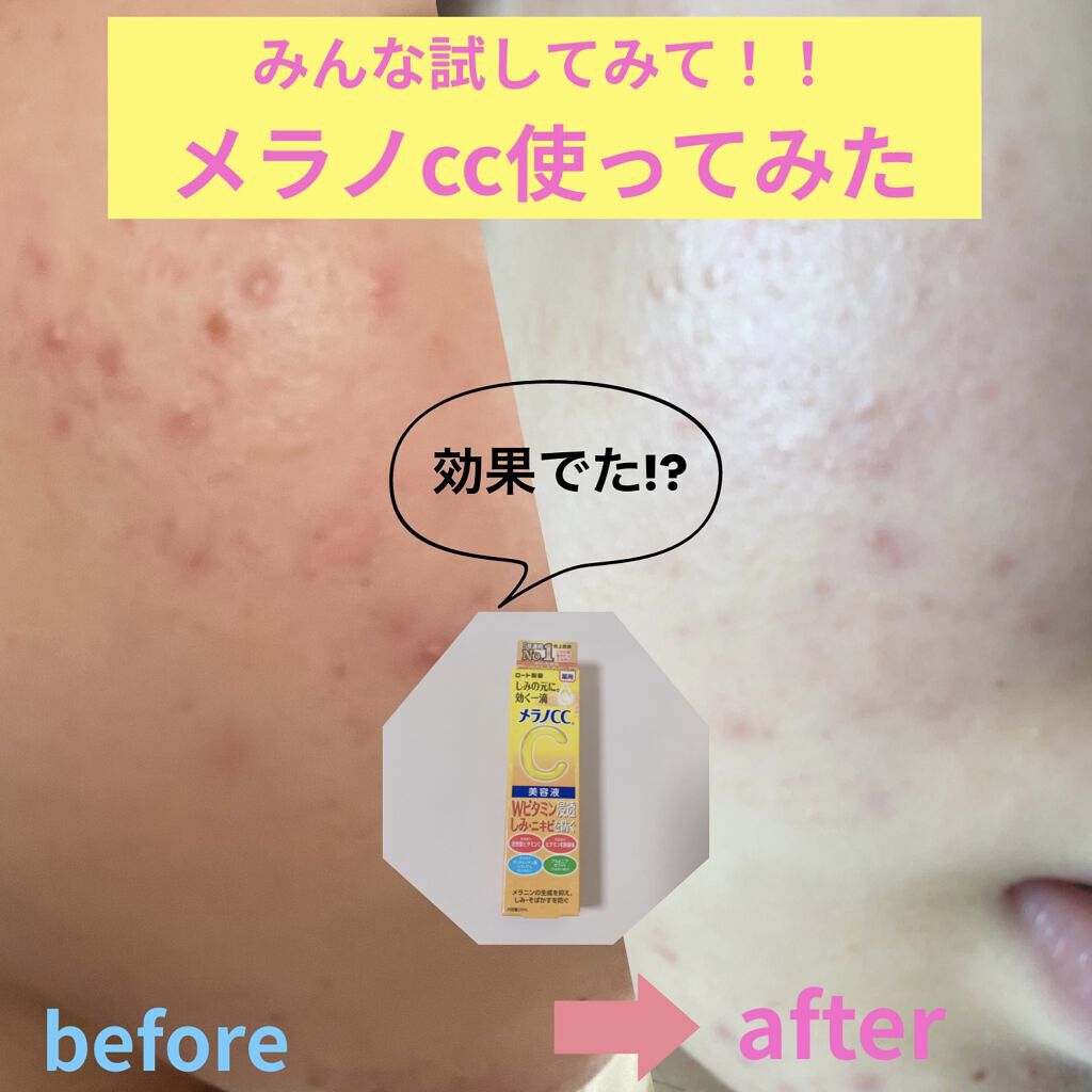 薬用 しみ 集中対策 美容液/メラノCC/美容液を使ったクチコミ（1枚目）