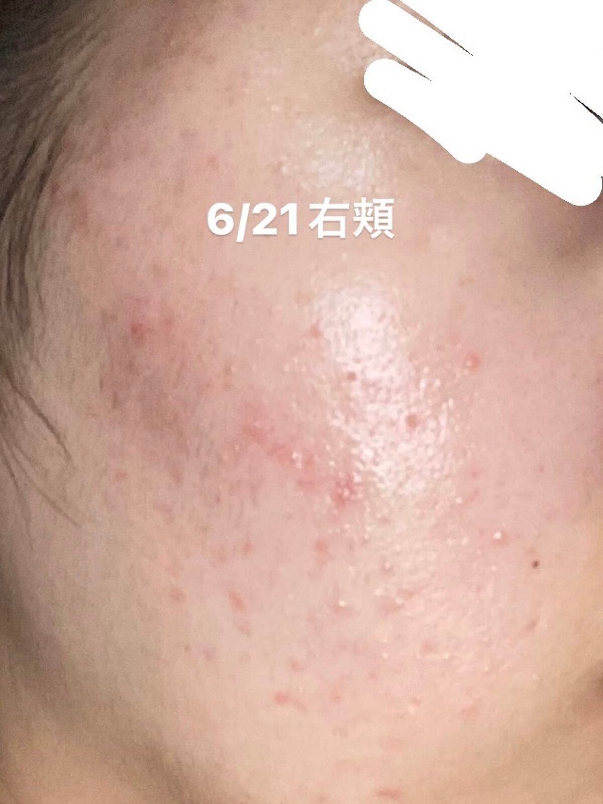 hm on LIPS 「ニキビ日記2日目皮膚科に行ってちょうど1週間が経ちました!今ま..」(2枚目)