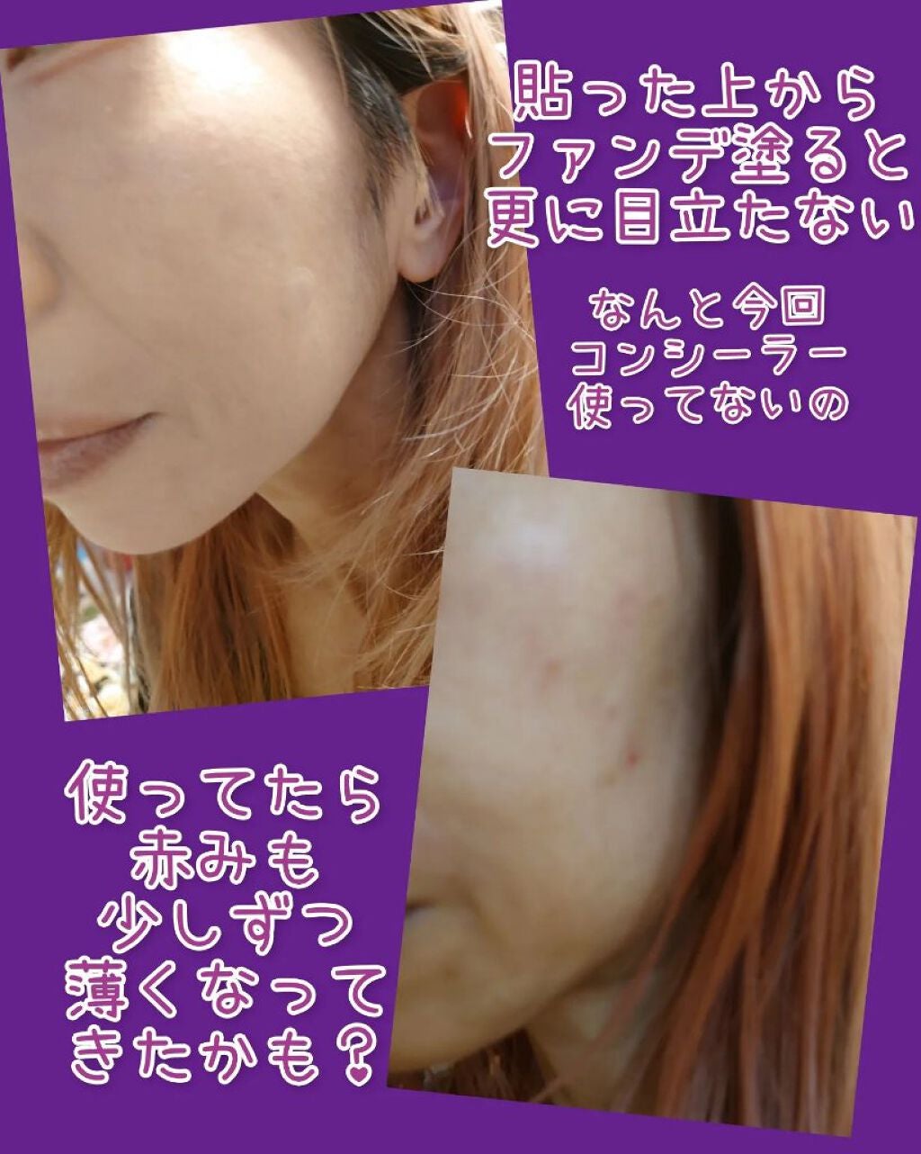 プロCICA クリアスポットパッチ/VT/その他スキンケアを使ったクチコミ(4枚目)